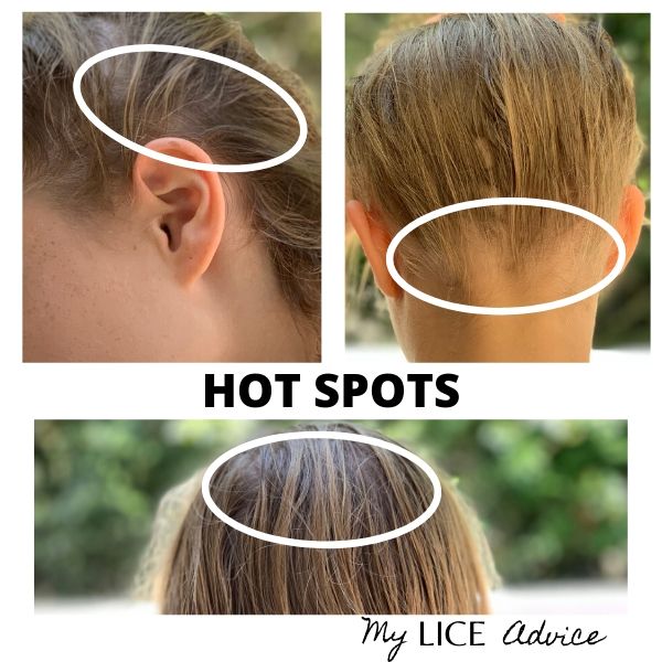 side-by-side images of blond girl's hair. Three circles identify the hot spots that lice usually lay lice eggs (nits)