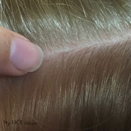 Pictures of What Lice Eggs (Nits) Look Like in Hair: 9 Tips to Spot Them