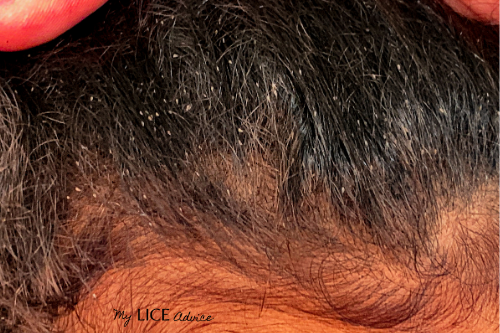 hundreds of lice eggs/nits in dark hair