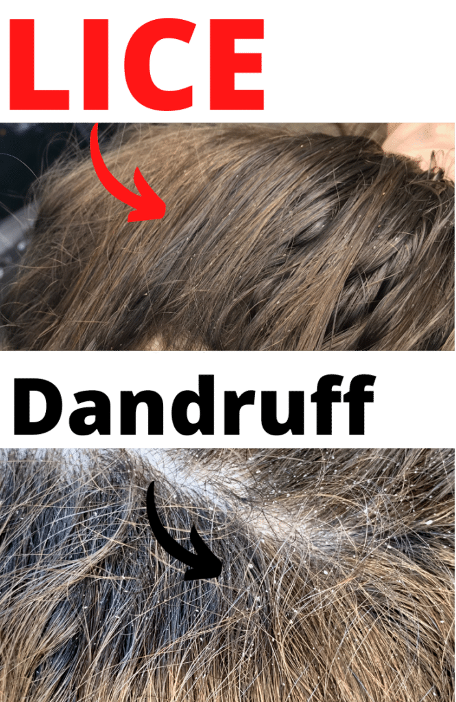 head lice vs dandruff pictures