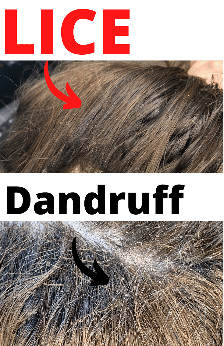 difference between lice eggs and dandruff