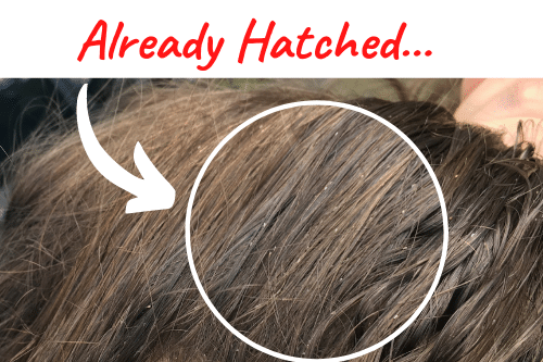 hatched lice eggs in hair