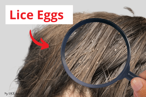 brunette with lice and several lice eggs, with a magnifying glass looking at lice eggs. Arrow pointing to lice eggs