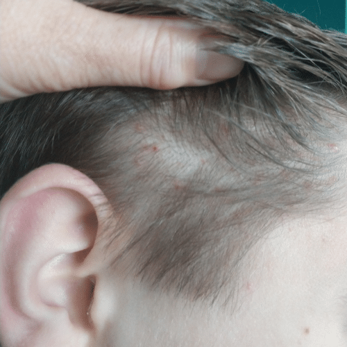 red, raised lice rash on the scalp. Appears as lice bites on the head