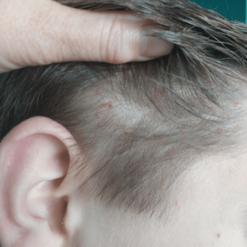 Albums 100+ Images head lice pictures of scalp Sharp