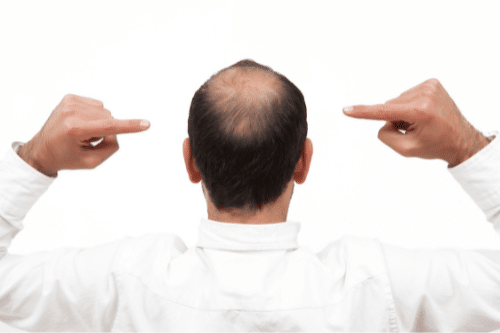 bald man pointing to his scalp