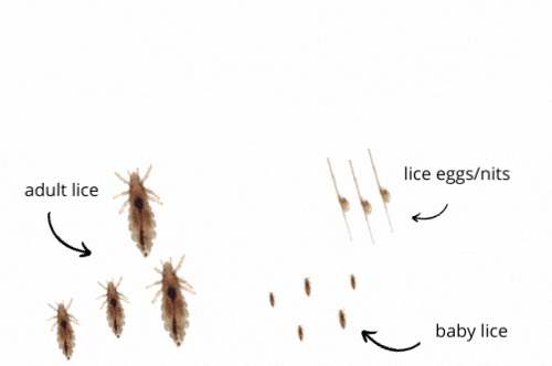 full lice infestation representation with lice eggs, baby lice bugs, and adult lice bugs