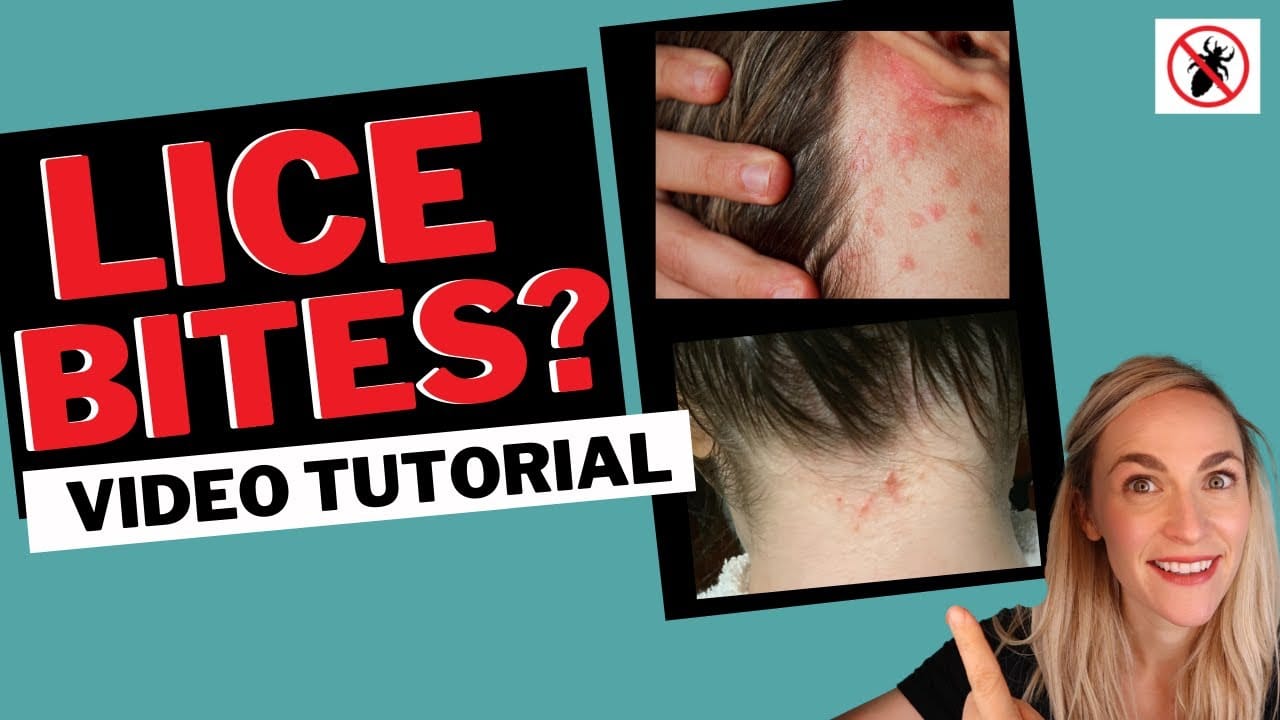 back of neck with lice bites, behind ears with large welt-like lice bites, lice expert pointing to the pictures