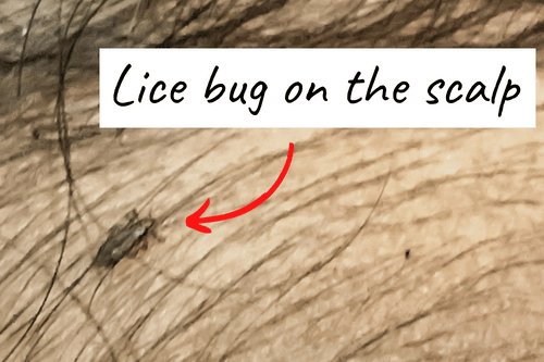 lice bug on the scalp of brunnette
