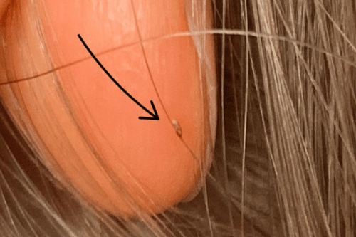 single brown lice egg on hair strand