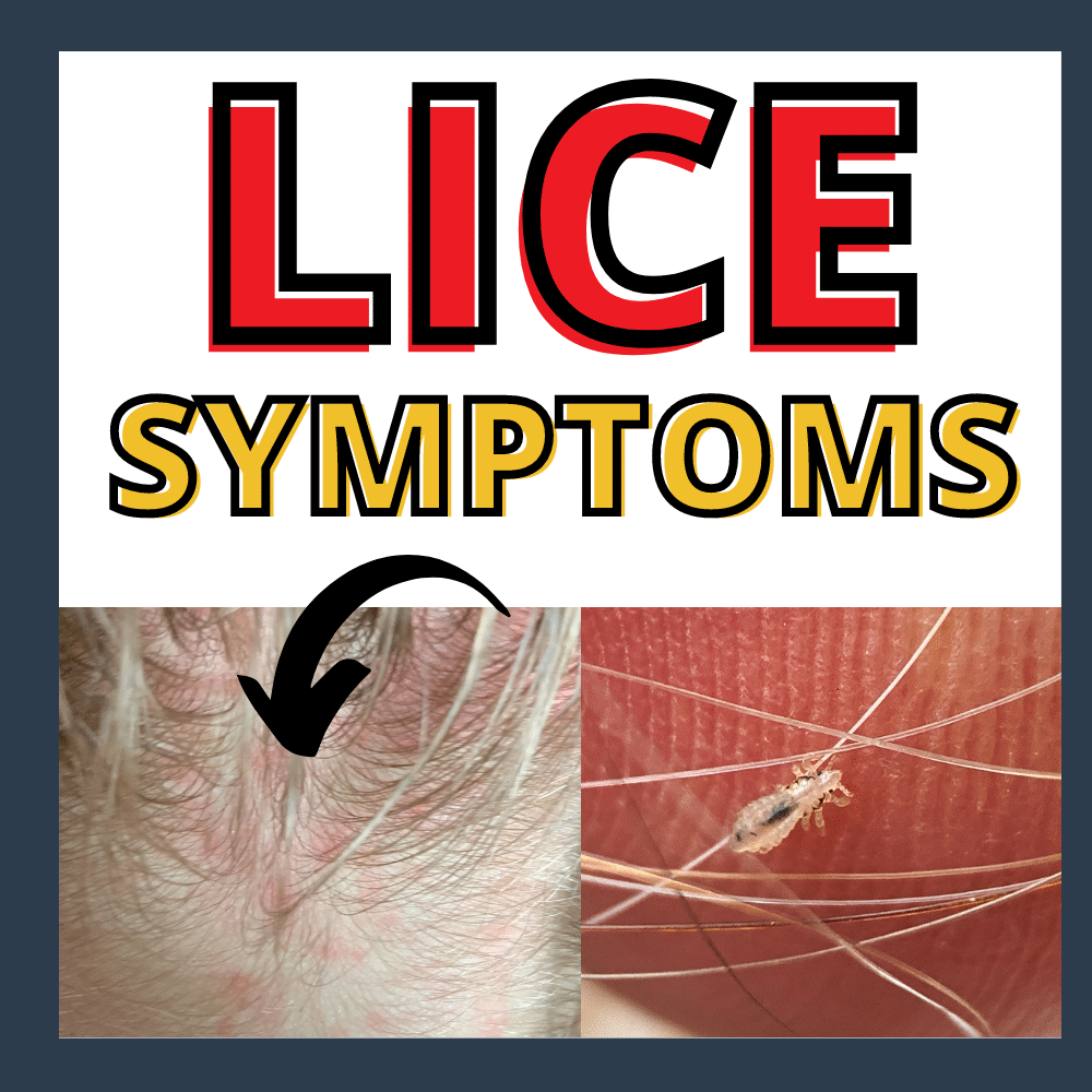 lice rash and lice bug. The words "lice symptoms"